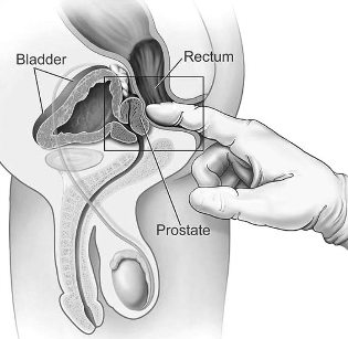 léčba zánět prostaty v domácí masáže