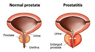 akutní prostatitida léčba