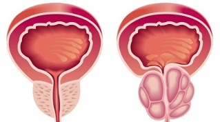 důvody pro vznik prostatitidy a adenomu prostaty